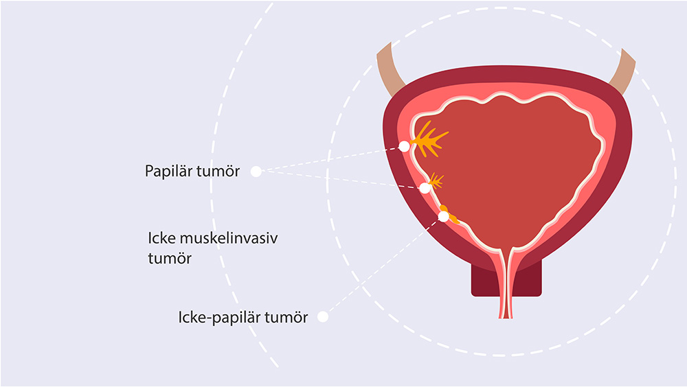 Genomskärning av en urinblåsa som illustrerar Papilär tumör, Icke muskelinvasiv tumör och Icke-papilär tumör.
