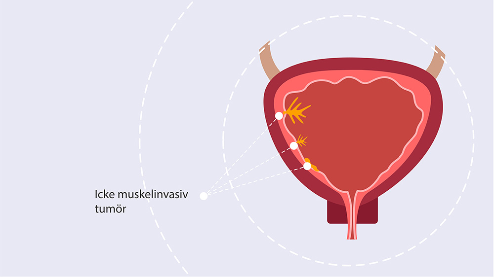 Genomskärning av en urinblåsa som illustrerar en icke-muskelinvasiv tumör.